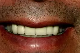 Close-up of a person's smile showing white teeth and natural lips against skin.