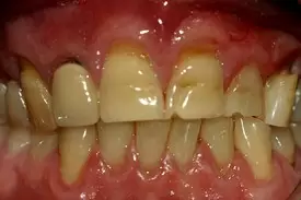 Close-up dental photograph showing upper and lower teeth with visible plaque buildup and gum inflammation.