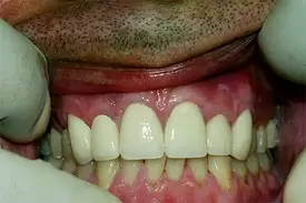Close-up of dental veneers displaying a bright, uniform smile with natural-looking tooth alignment.