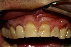 Close-up of upper front teeth showing discoloration and gum inflammation in dental clinical setting.