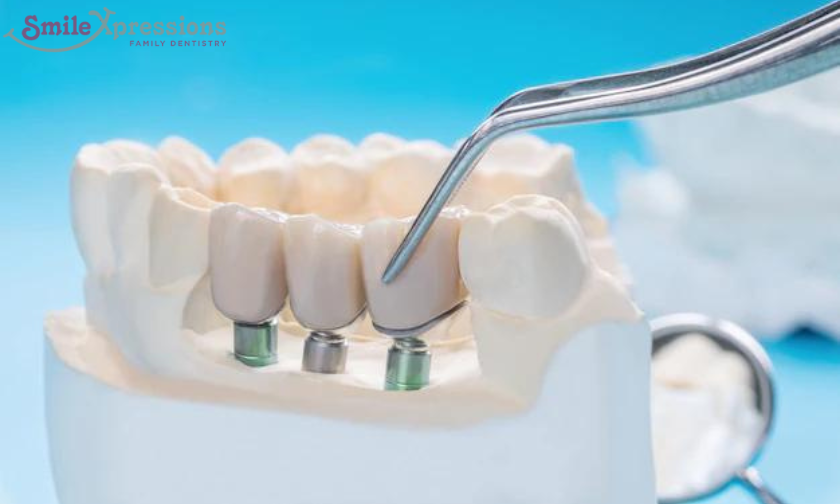 Different Types Of Dental Crowns For You To Have A Pretty Smile