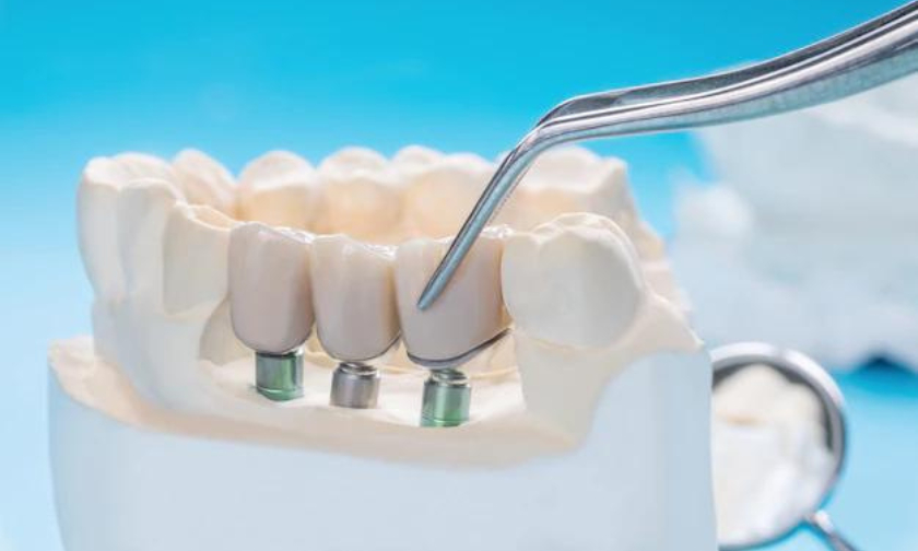Factors You Should Consider While Choosing Your Implant Dentist
