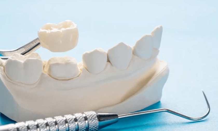 Things To Know About Dental Crowns
