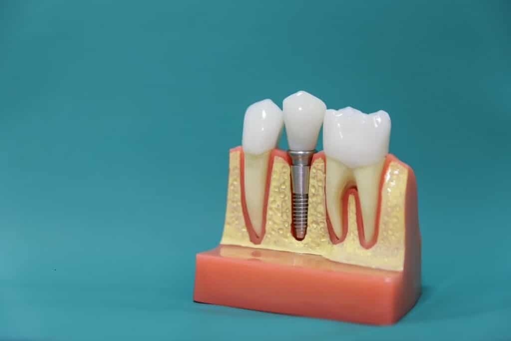 5 Factors To Consider Before Choosing An Implant Dentist