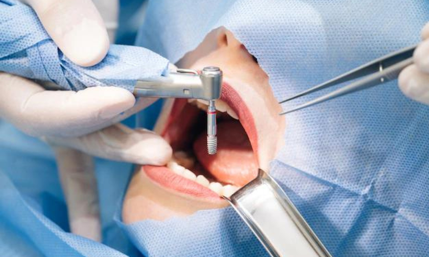 Dental Implants Artesia