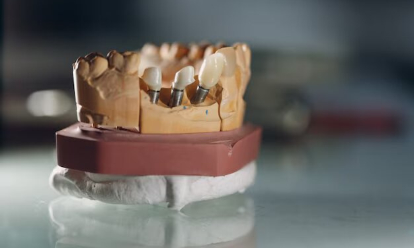 Dental Implants Artesia
