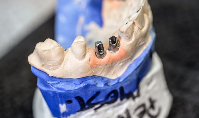 The Role of Dental Implants in Full-Mouth Reconstruction