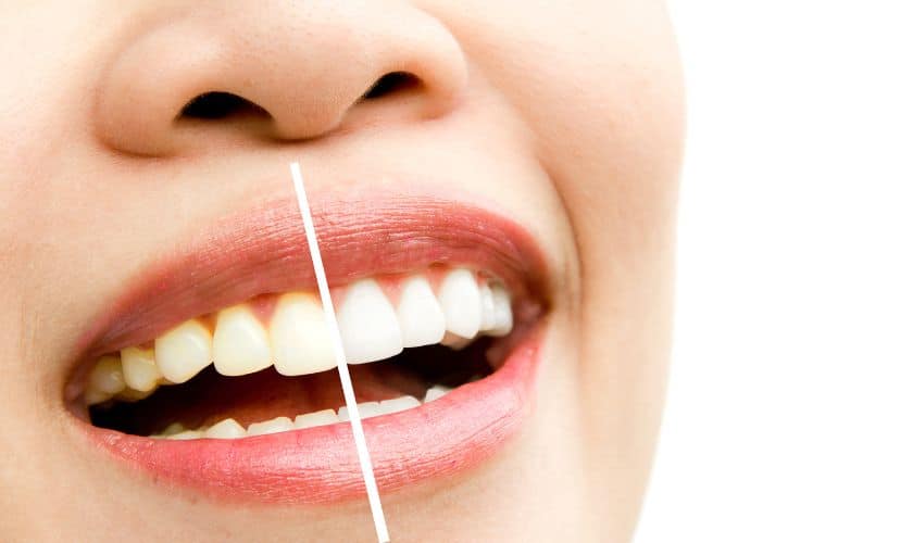 Teeth Whitening And How To Prevent Tooth Stains