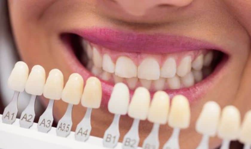 Veneers in Artesia