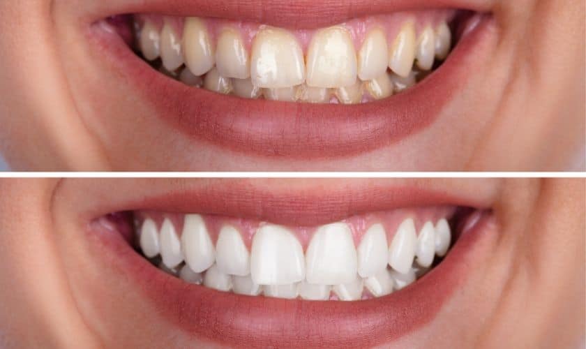 The Benefits of Professional Teeth Whitening in Artesia