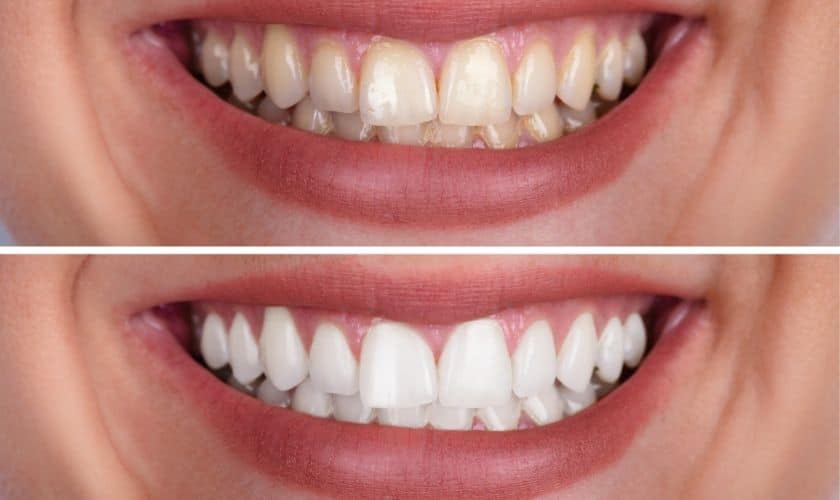 Professional Teeth Whitening