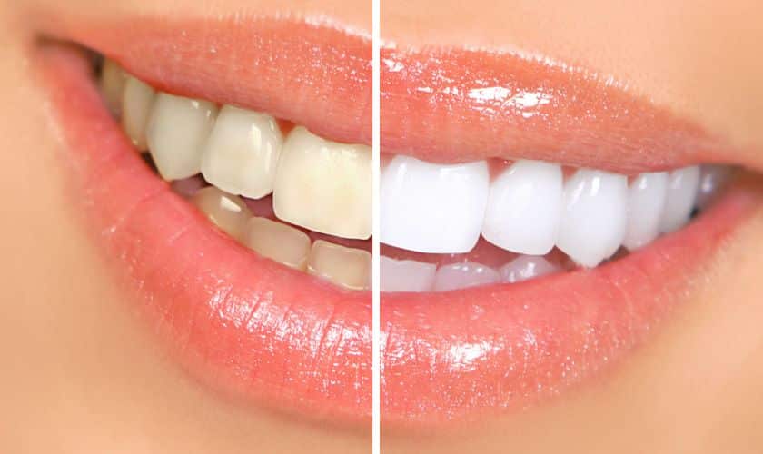 The Most Popular Cosmetic Dentistry Procedures and Their Benefits