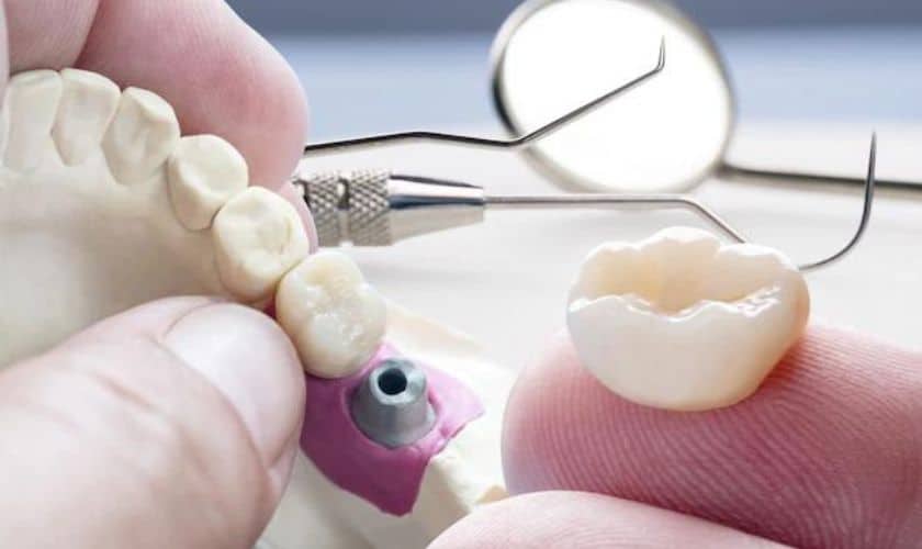Dental Crowns in Artesia