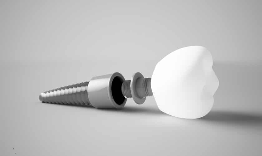 Dental Implants Artesia