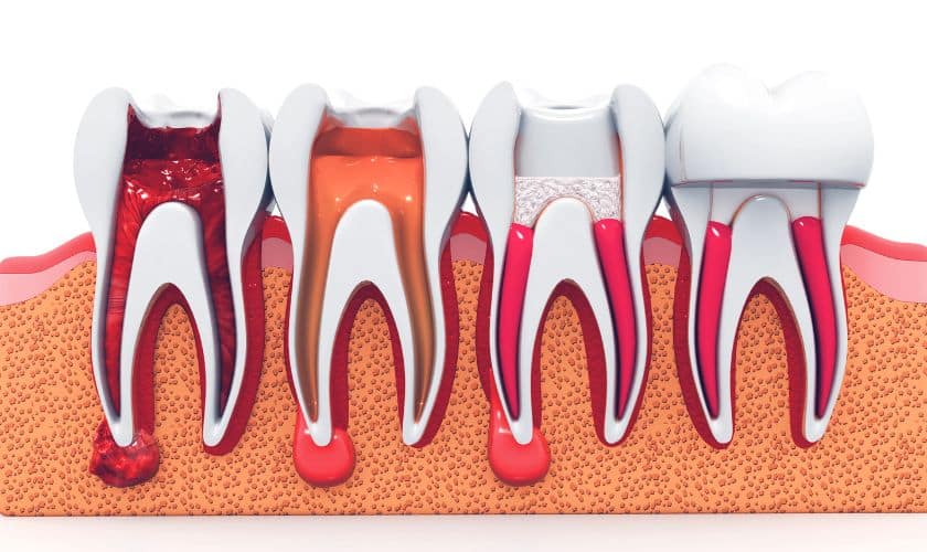 Root Canal Therapy Artesia
