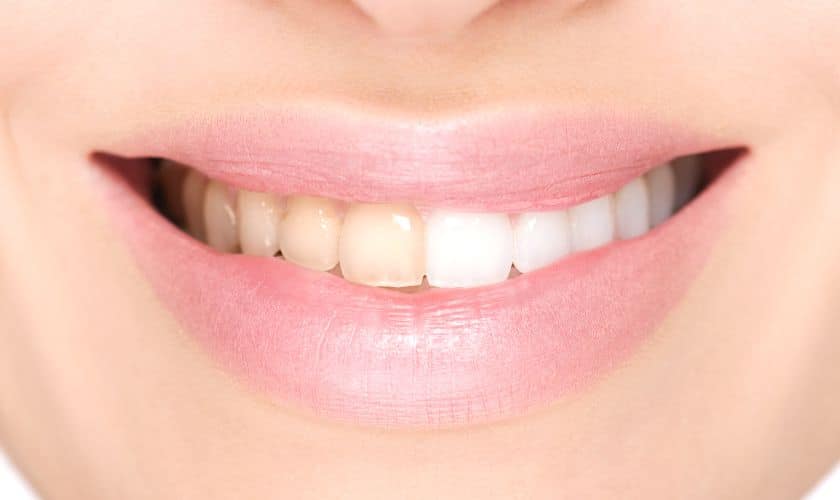 Can Yellow Teeth Become White Again