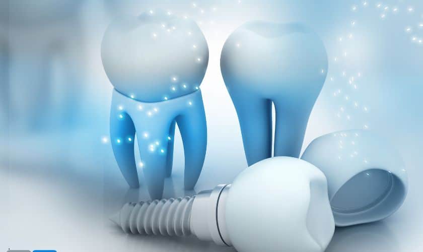 Dental Implants Artesia
