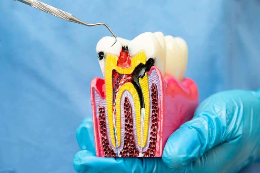 Root canal Therapy model for explanation