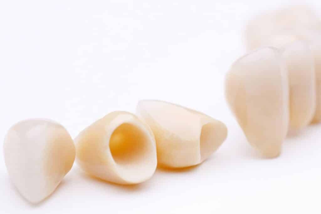 dental crowns in Artesia