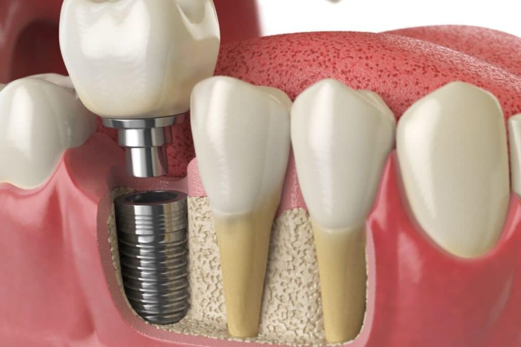 dental implants Artesia