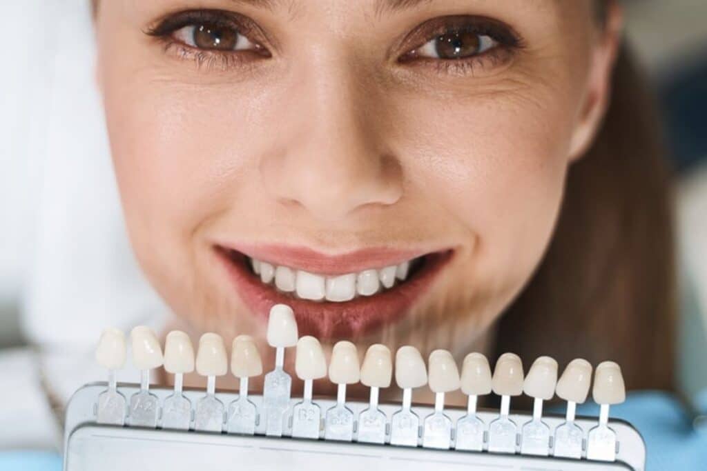 dental veneers in Artesia