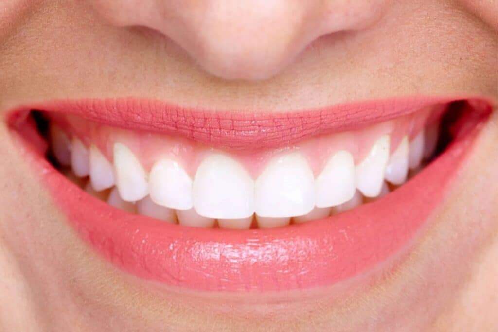 Bright white smile after professional teeth bleaching in Artesia, NM