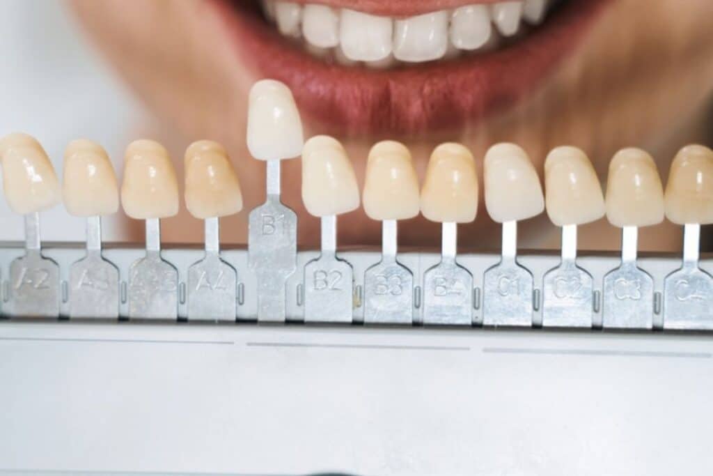 Porcelain Veneers in Artesia, NM
