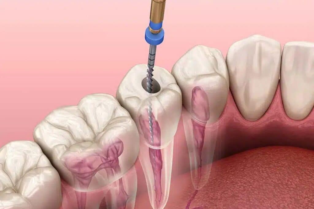 Illustration showing the root canal process