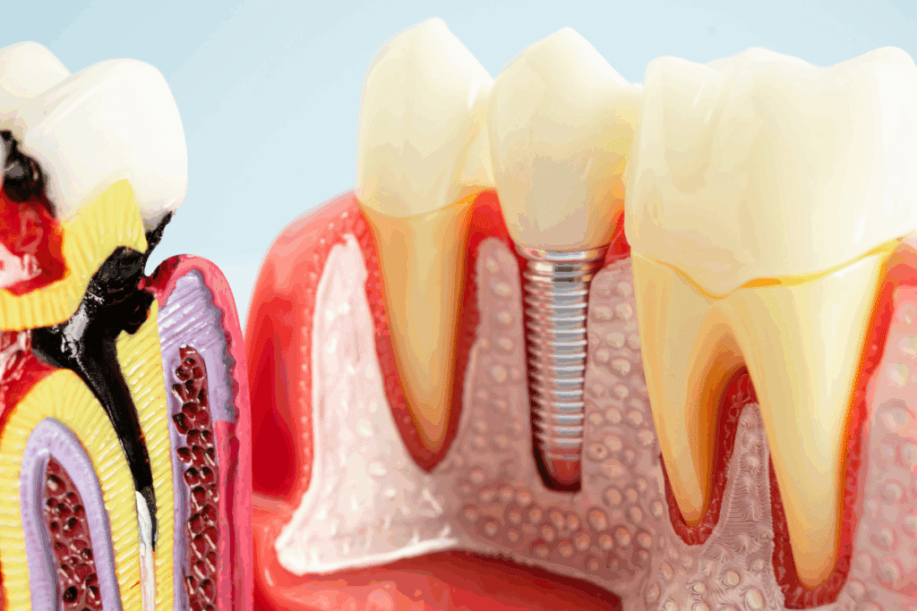 Dental Implants