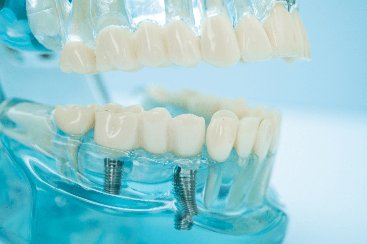 Tooth Replacement Solution