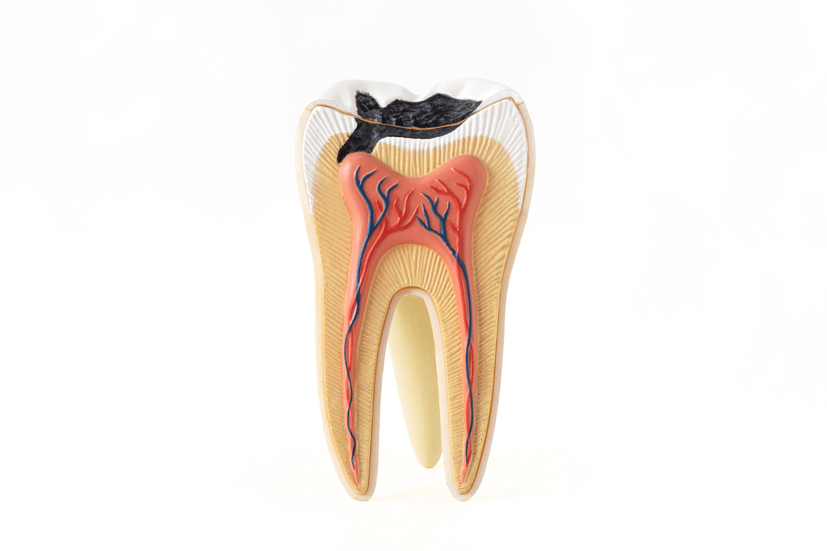 root canal therapy