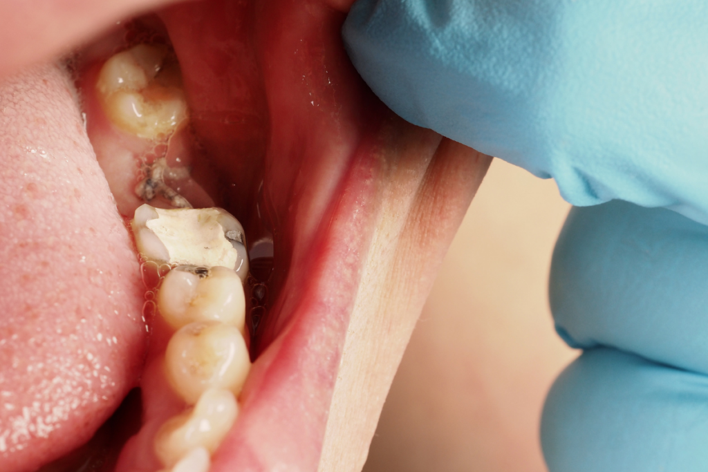 dental fillings