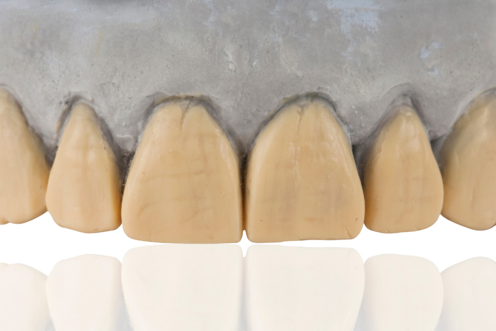 dental crowns