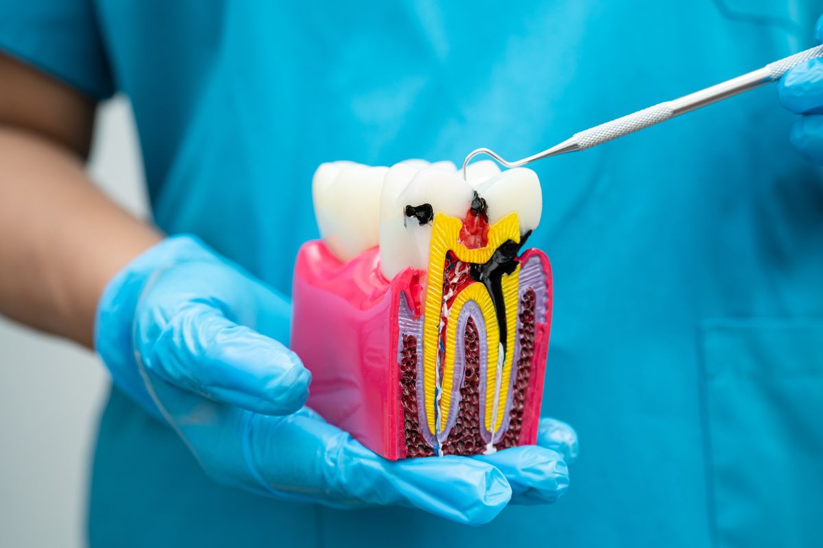 Root Canal Therapy