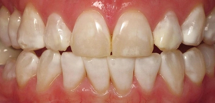 Crowded, misaligned teeth Before