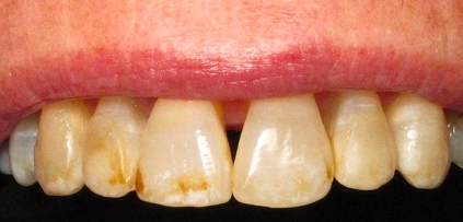 Gapped, stained front teeth Before