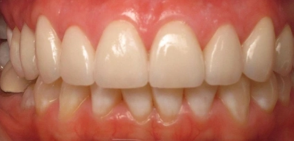Straight, aligned teeth After