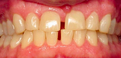Uneven, crowded teeth Before image