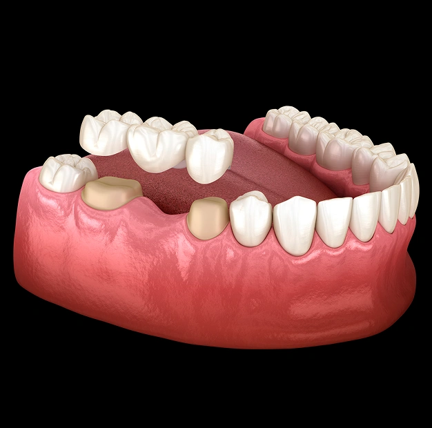 Closing the Gap in Your Smile