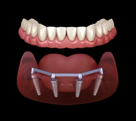 3D illustration of All-on-4 and All-on-X dental implants with full arch bridge