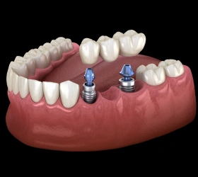 3D illustration of implant-supported dental bridge replacing missing back teeth