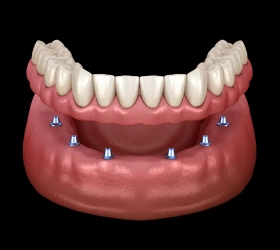 Implant Supported Dentures