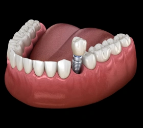 Single Tooth Implants