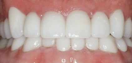 Full Mouth After