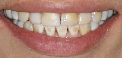 Smile Transformation before
