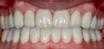 traight, balanced smile After Image