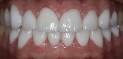 After photo of patient's improved smile following treatment at Smile Xpressions Dentistry in Artesia, NM