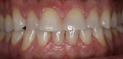 Before photo of patient's teeth prior to treatment at Smile Xpressions Dentistry in Artesia, NM