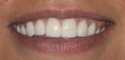 After photo of patient's smile following veneers at Smile Xpressions Dentistry in Artesia, NM
