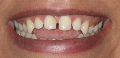 Before photo of patient's teeth prior to veneers at Smile Xpressions Dentistry in Artesia NM